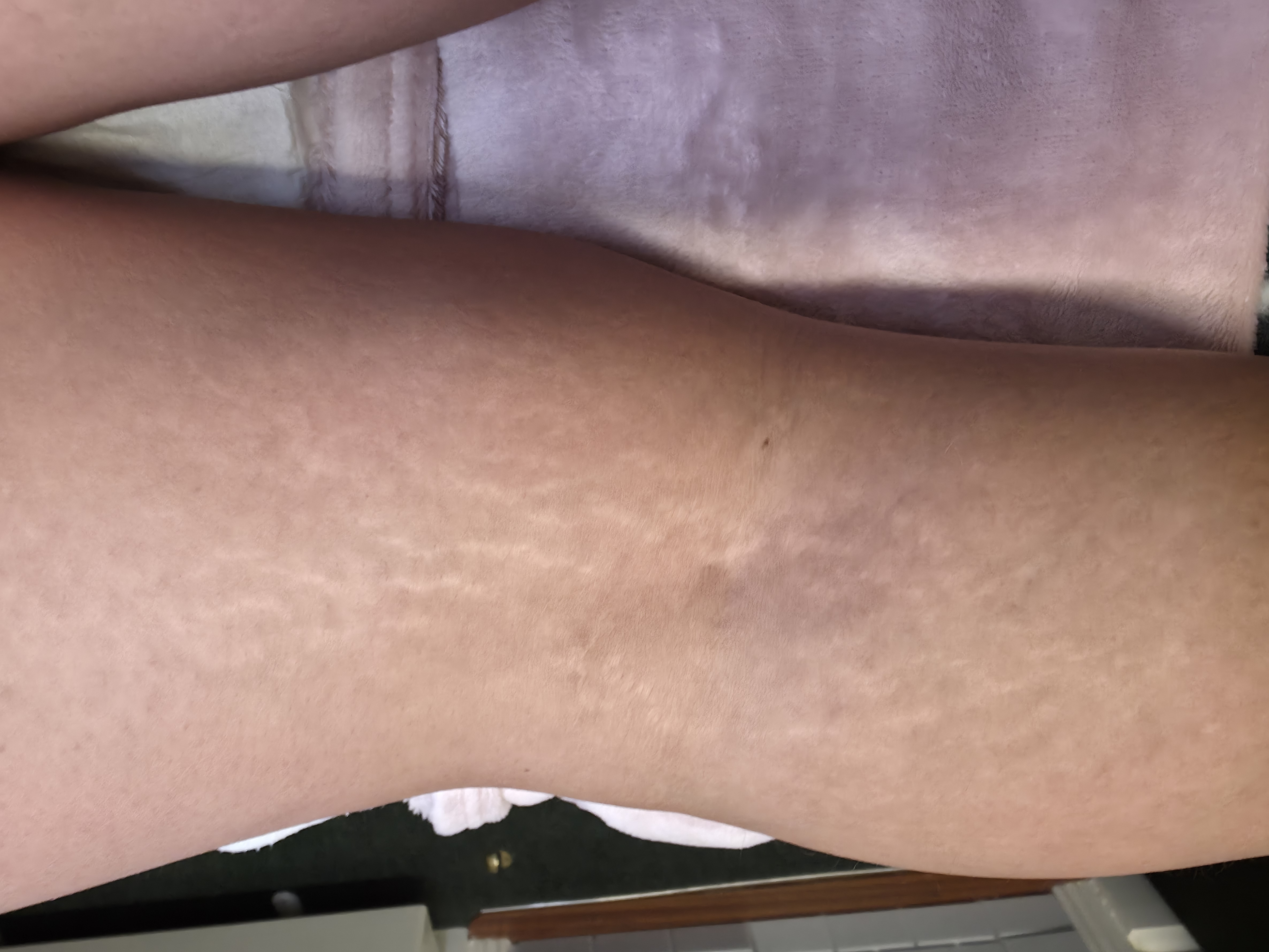 Before Dermapoint Protocol — stretch marks on thigh